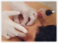 皮膚刺絡（三稜鍼と吸い玉を併用）
